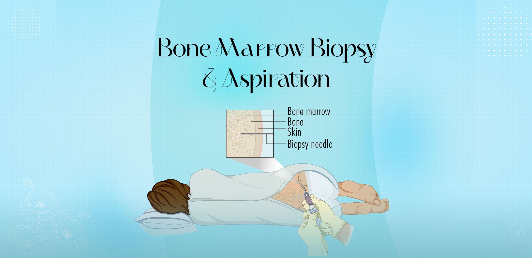 Bone Marrow Biopsy & Aspiration