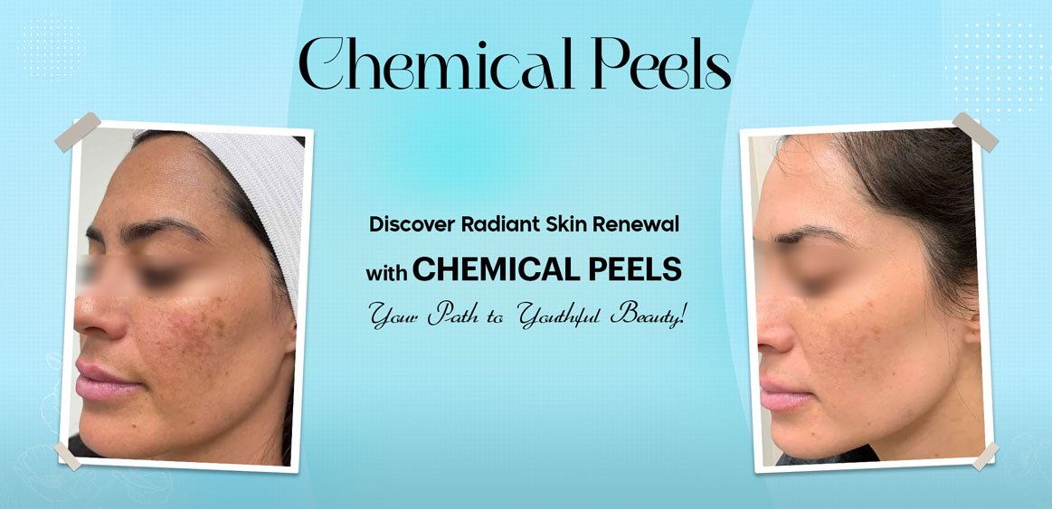 Chemical Peels