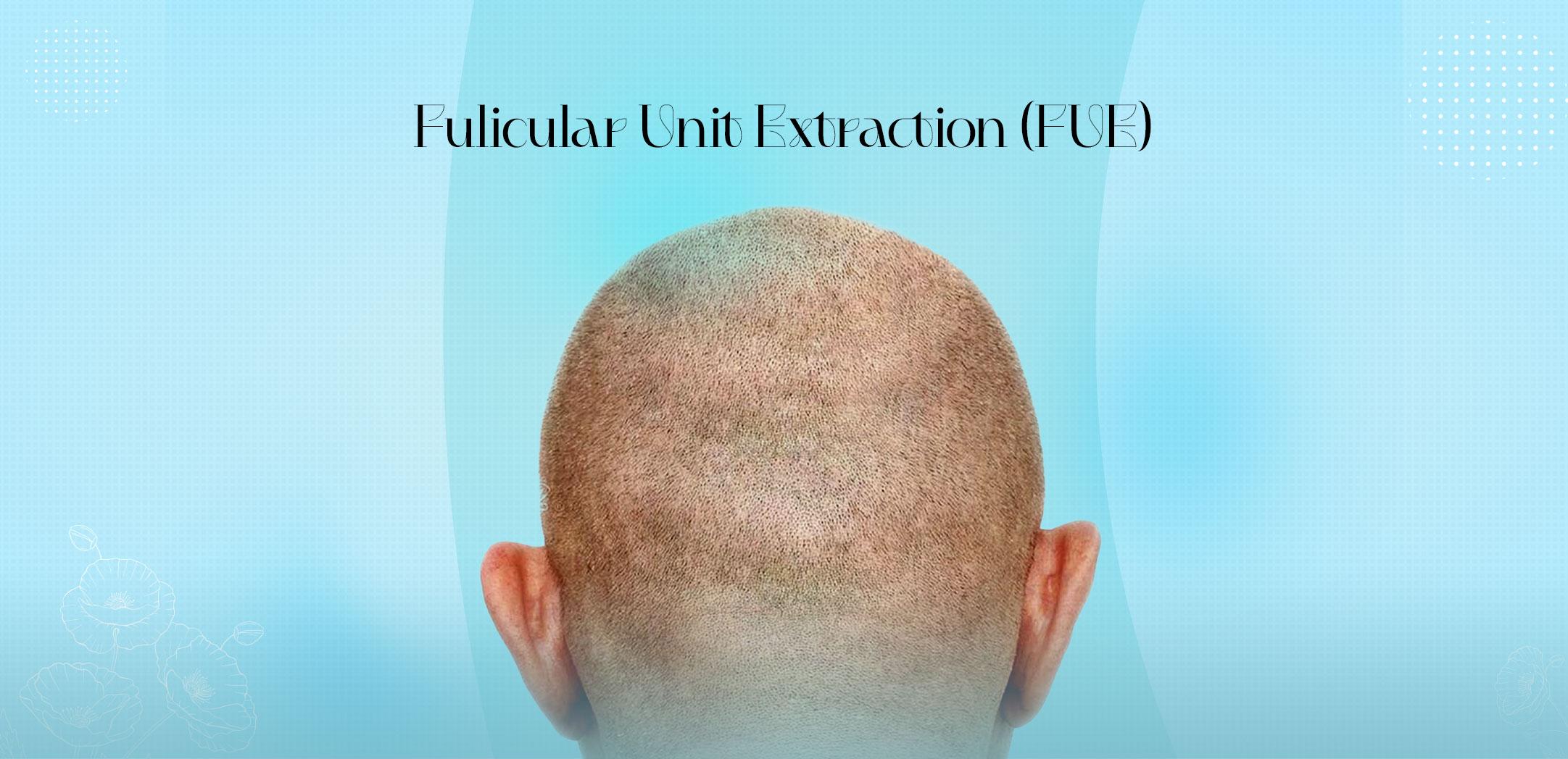 Fulicular Unit Extraction (FUE)