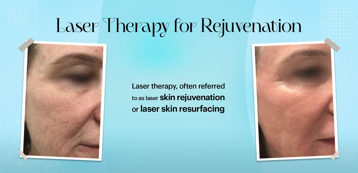 Laser Therapy for Rejuvenation