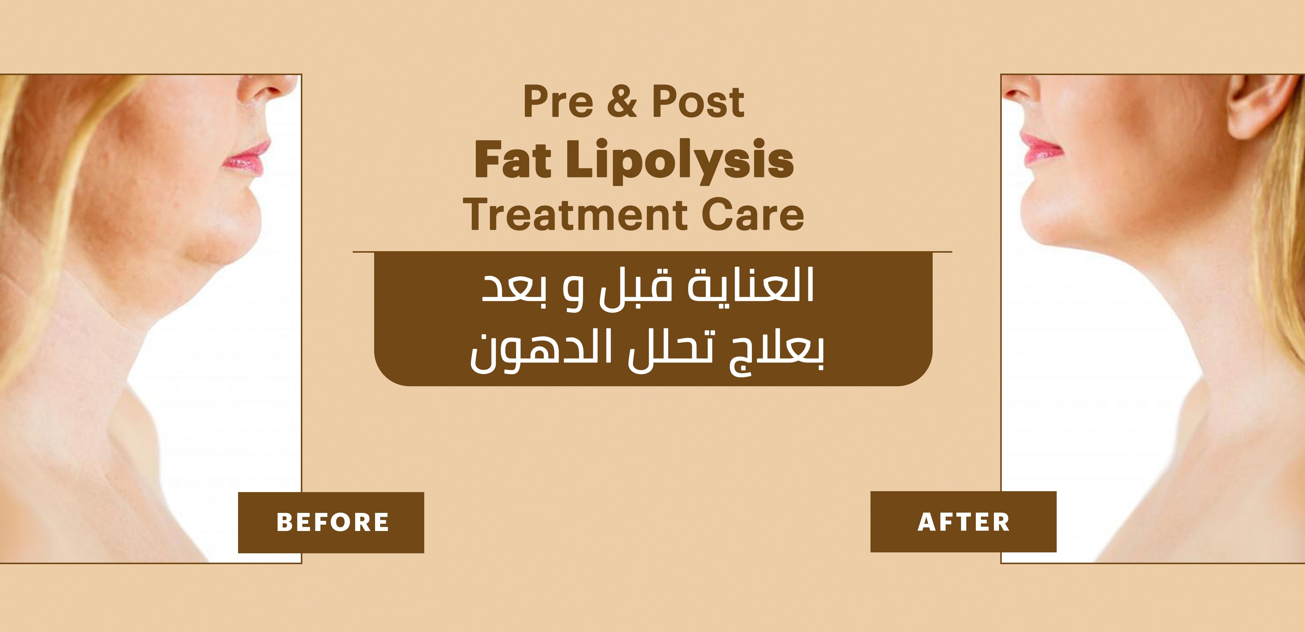 MESOTHERAPY LL