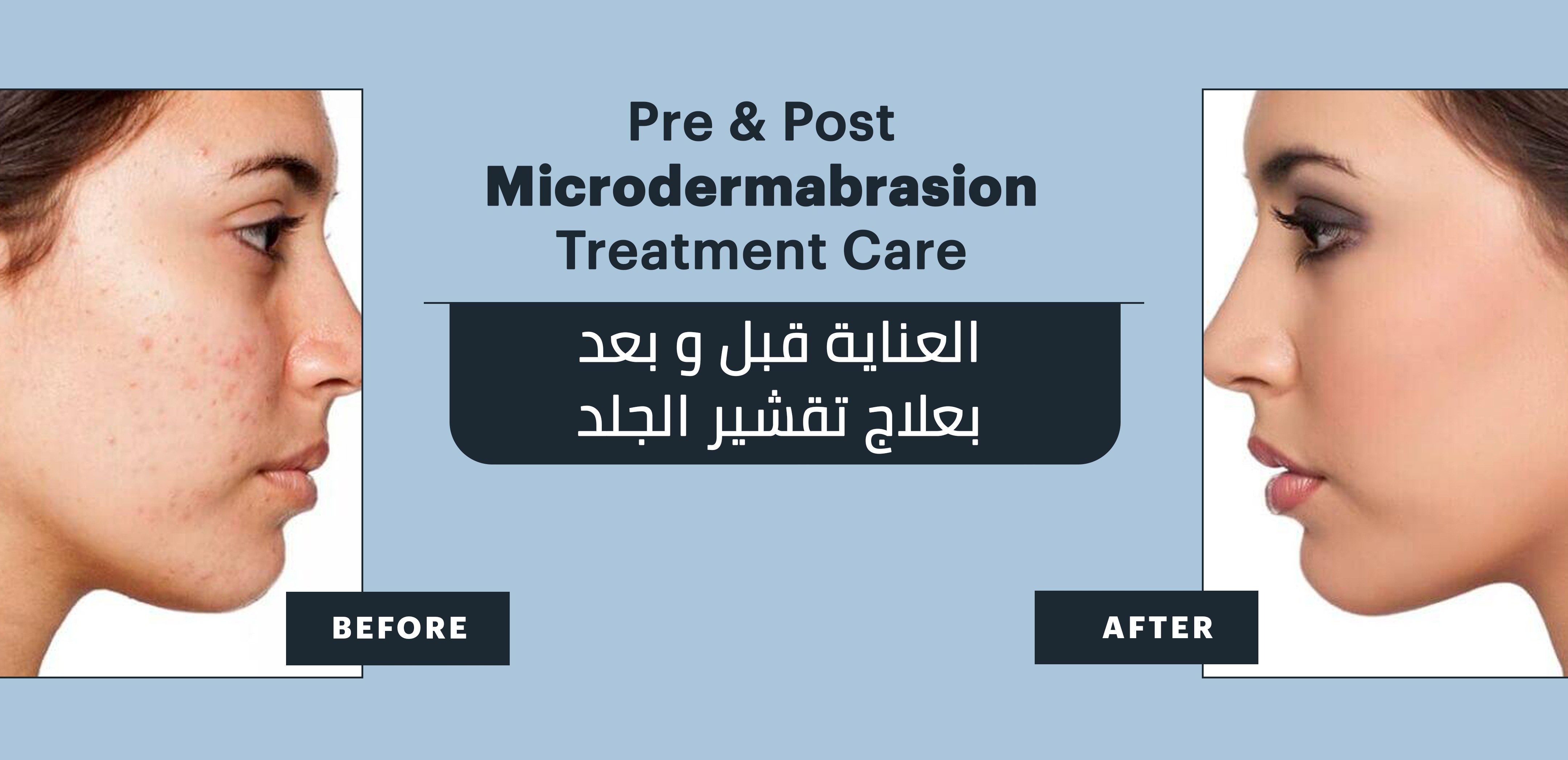 Microdermabrasion