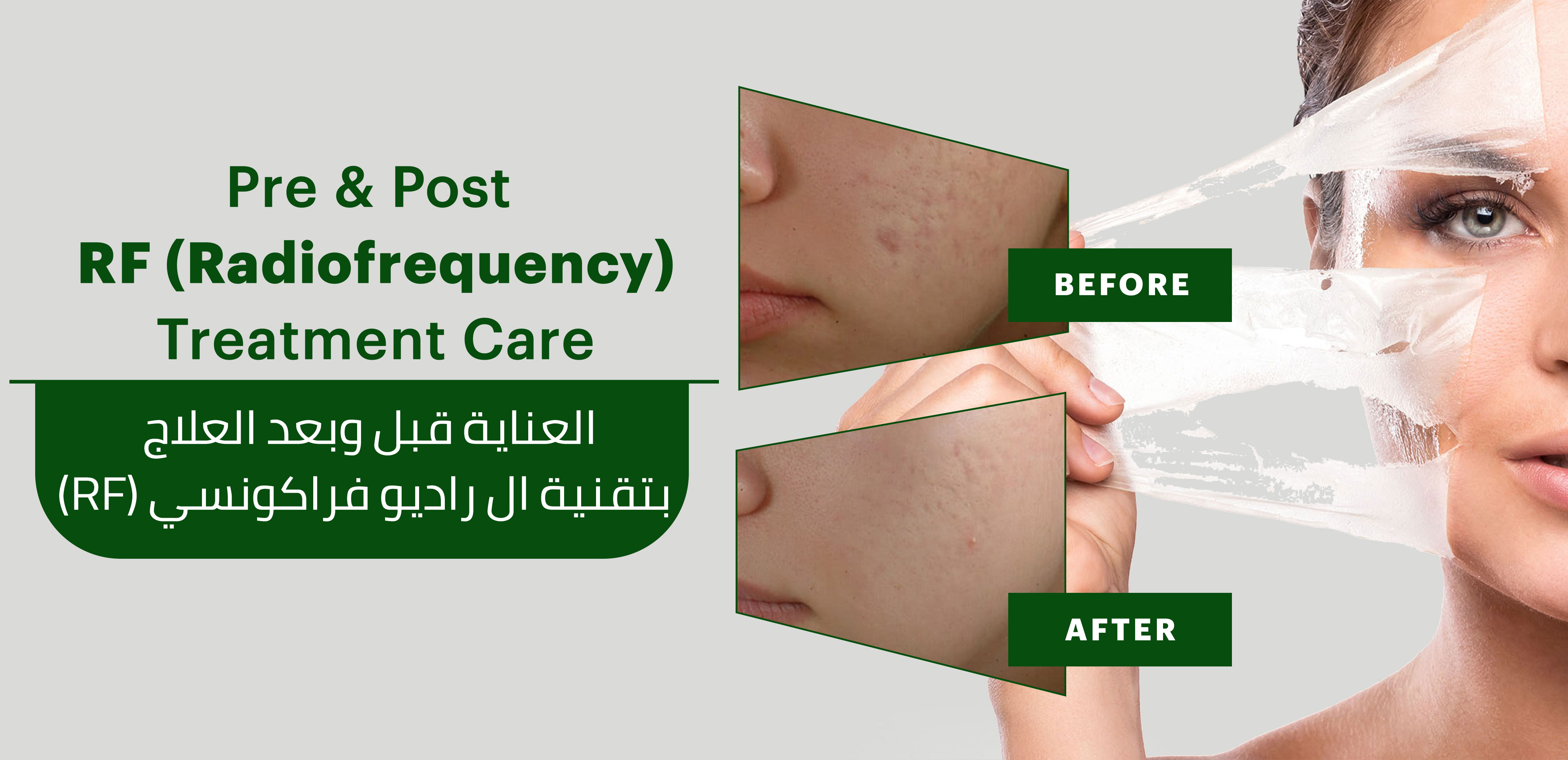 PRE & POST RF RADIOFREQUENCY