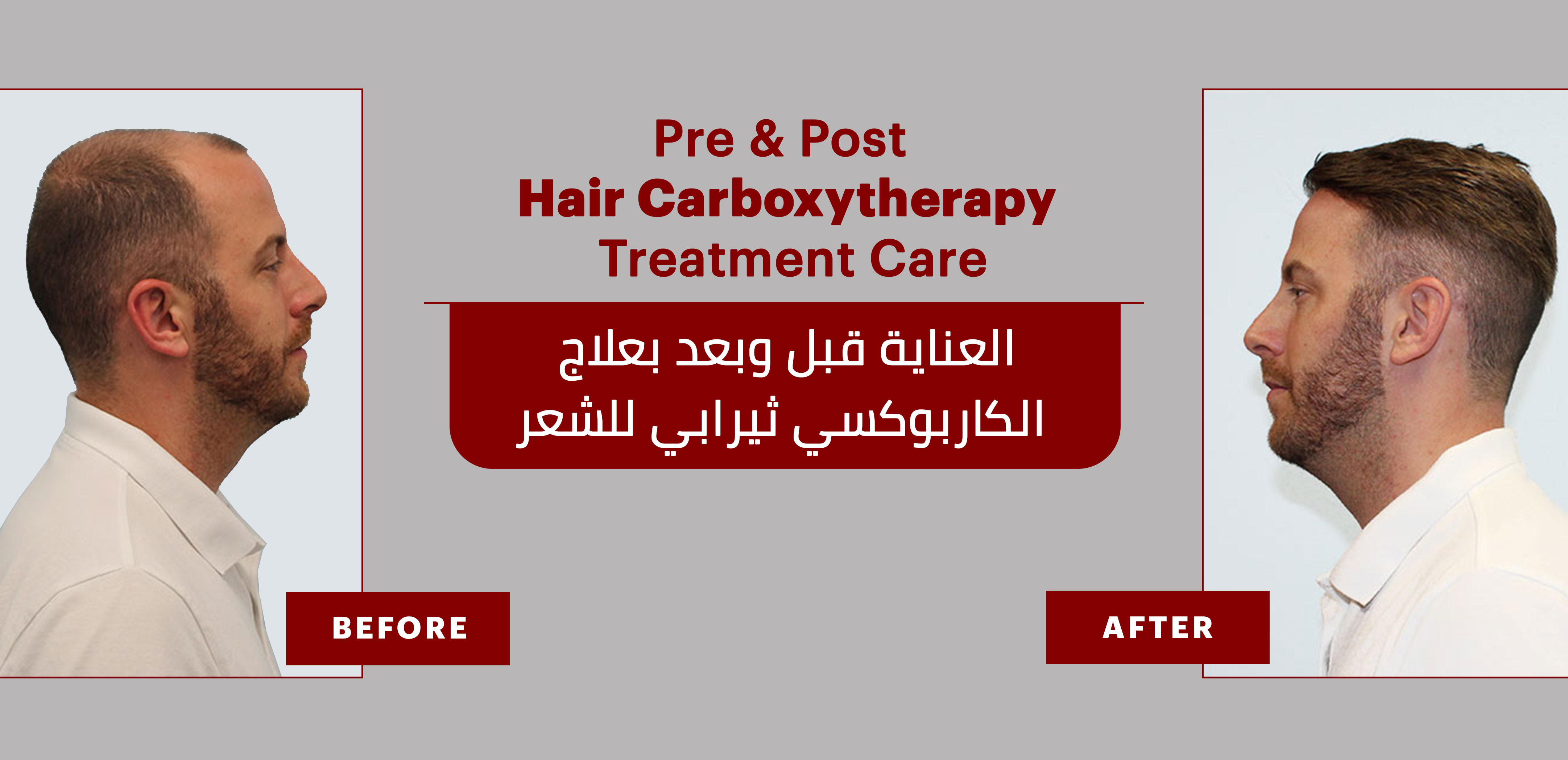 PRE & POST HAIR CARBOXYTHERAPY TREATMENT INSTRUCTIONS