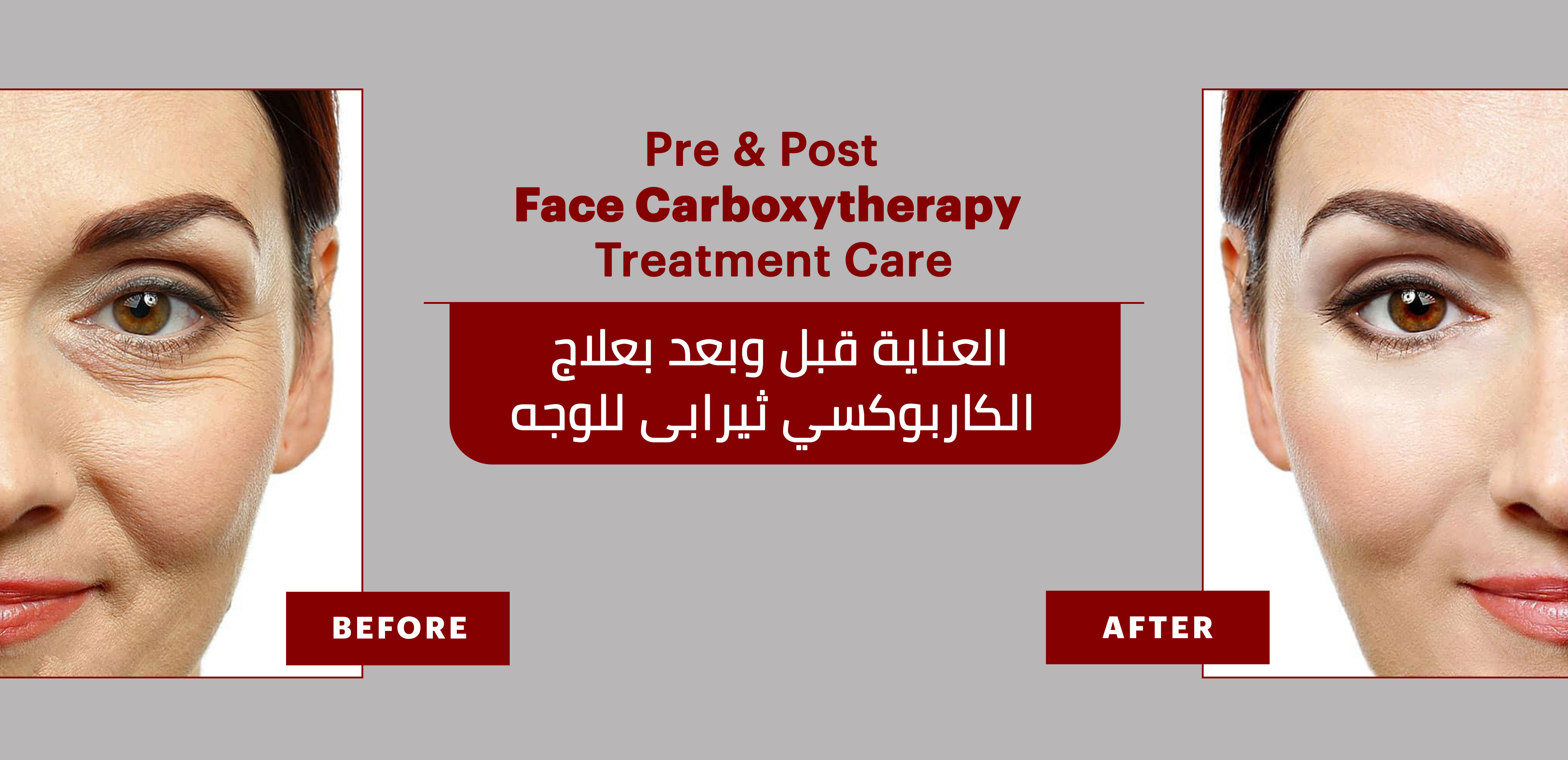 PRE & POST FACE CARBOXYTHERAPY TREATMENT INSTRUCTIONS