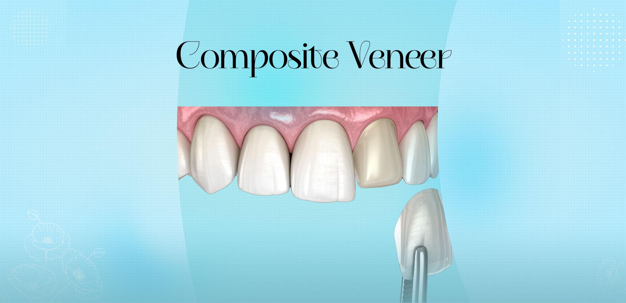 Composite Veneer