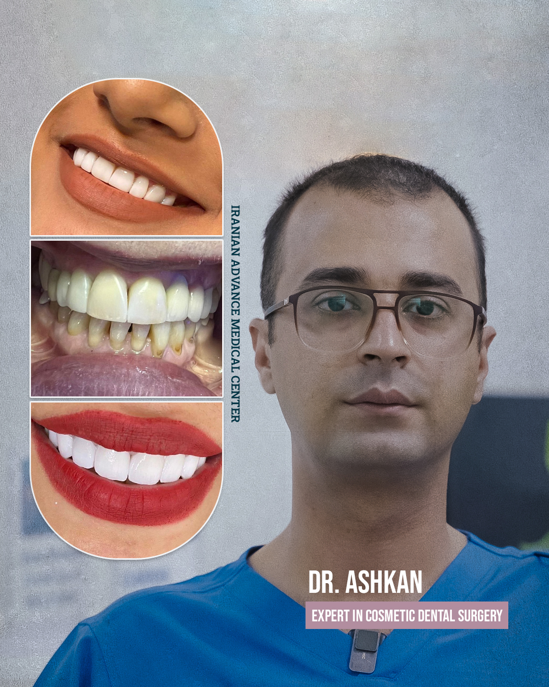 Hollywood Smile | Scaling and Polishing