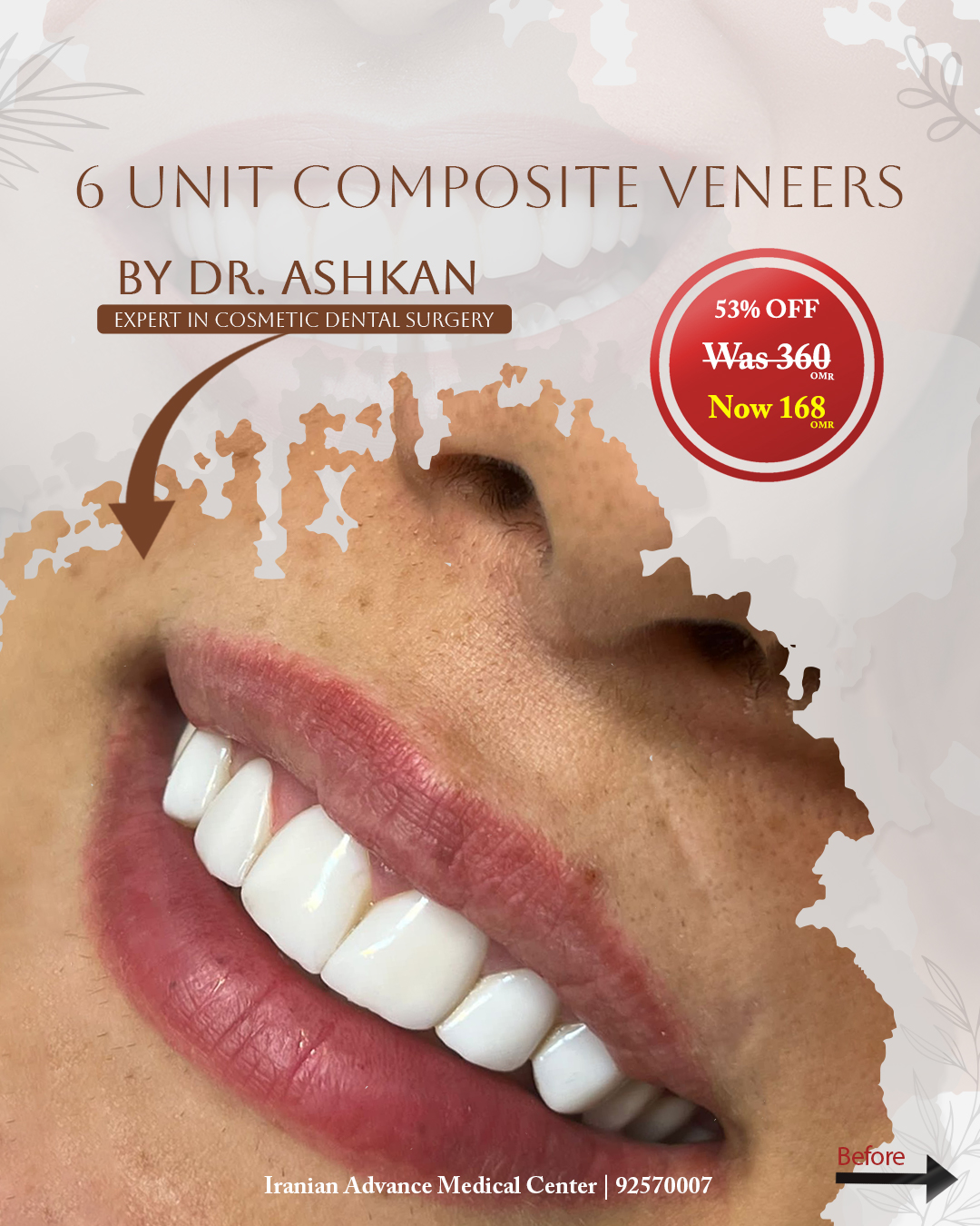 Hollywood Smile | Composite Veneer