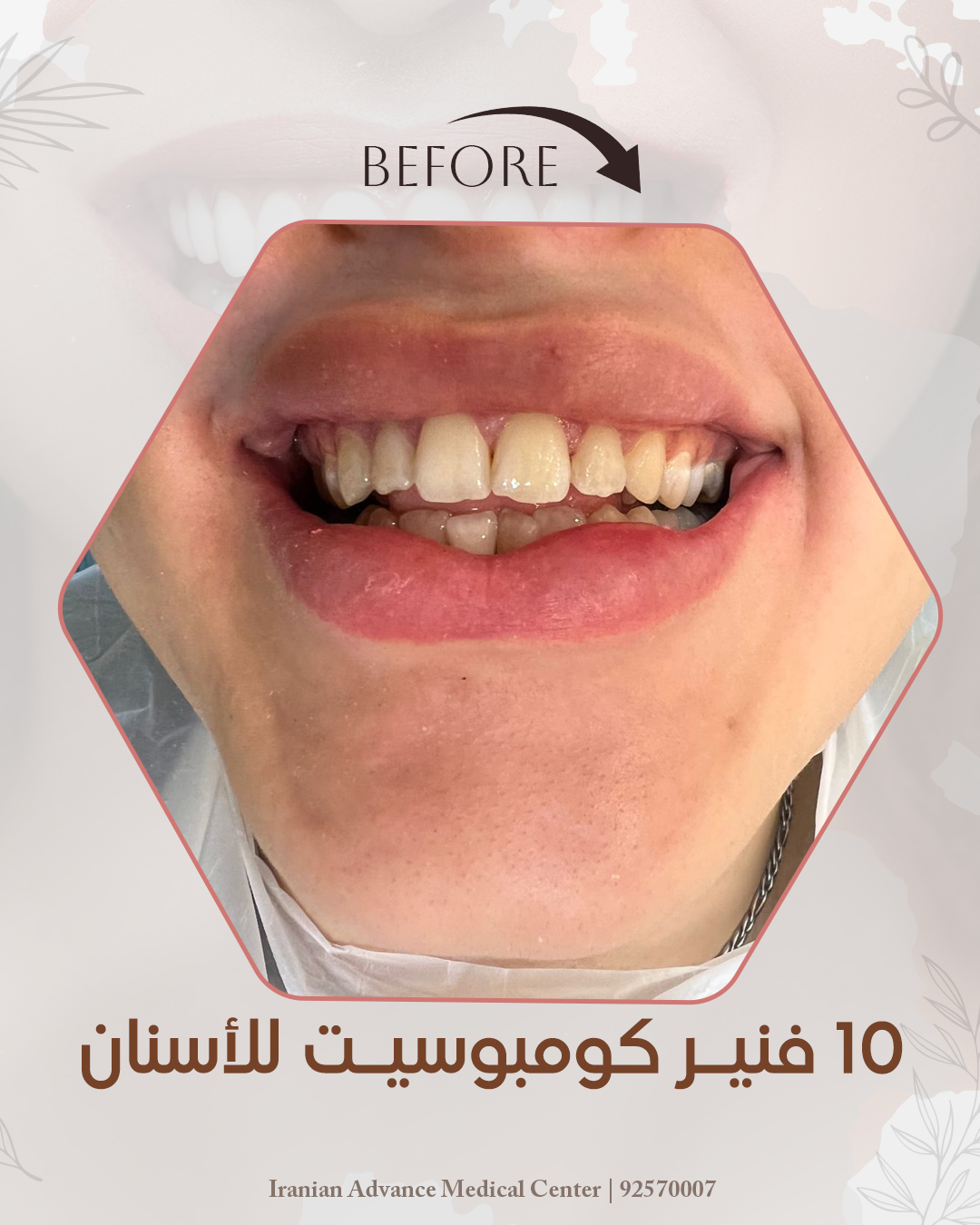 Hollywood Smile | Composite Veneer