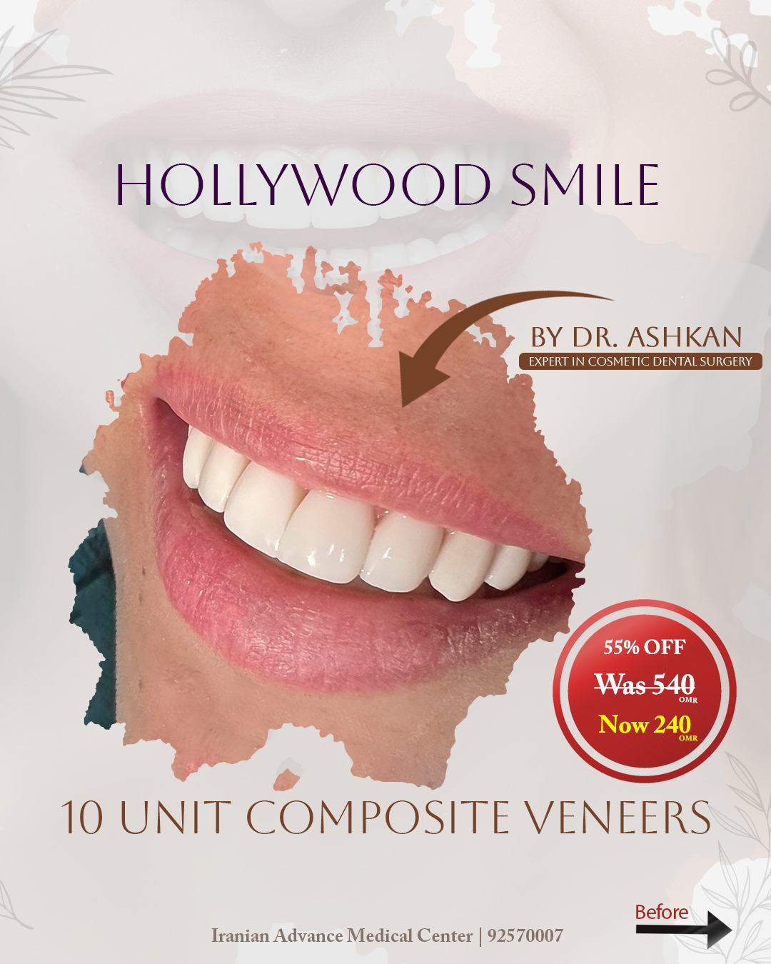 Hollywood Smile | Composite Veneer